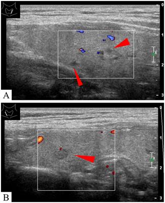 Diagnosis of bilateral pharyngoesophageal diverticula with using swallow contrast-enhanced ultrasound: a case report